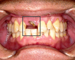「前歯 site:http://www.8181118.com/」の画像検索結果