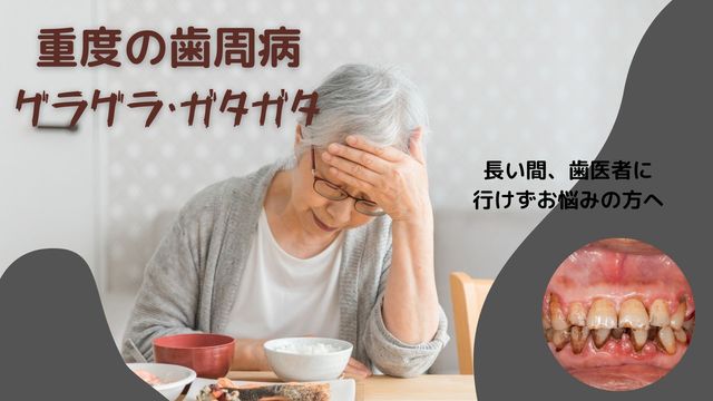重度の歯周病・歯がグラグラ・歯医者に行けていないお悩みは香川県高松市の吉本歯科医院