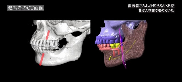 噛める入れ歯なら香川県高松市の噛み合わせ専門歯科　吉本歯科医院