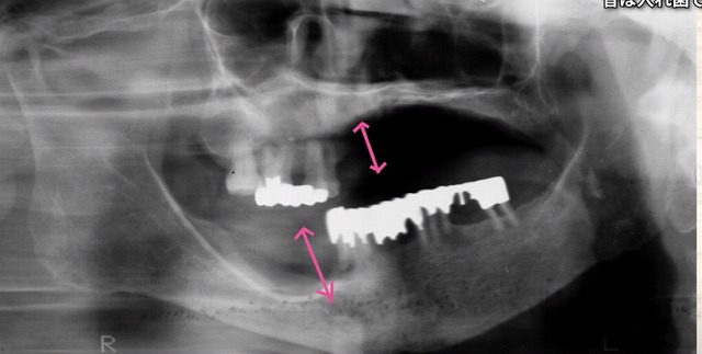 噛める入れ歯なら香川県高松市の噛み合わせ専門歯科　吉本歯科医院