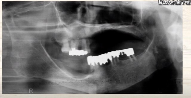 痛くなく噛める入れ歯｜香川県高松市の噛み合わせ専門　吉本歯科医院