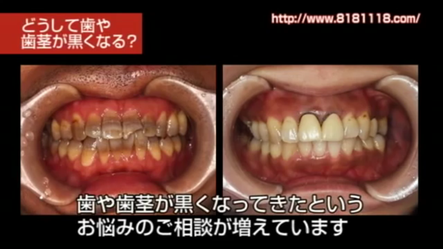 意外に知らない！治療した歯や歯茎が黒くなってくる原因 日本補綴歯科 ...