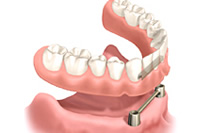 固定式入れ歯｜香川県高松市の吉本歯科医院