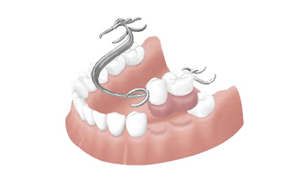 抜歯した後の治療の選択肢｜香川県高松市の吉本歯科医院