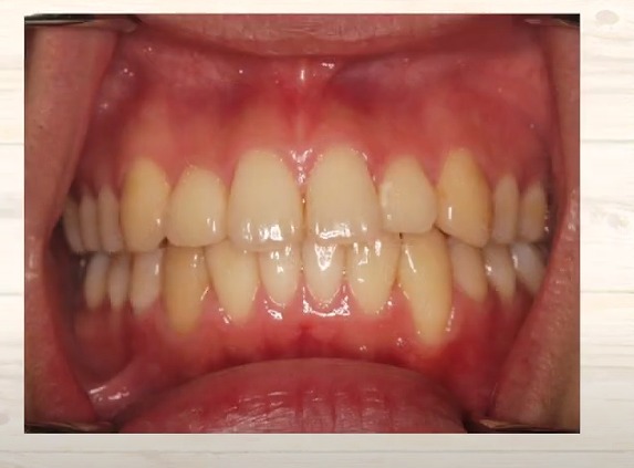 顔の筋肉の老化は噛み合わせ｜香川県高松市の吉本歯科医院