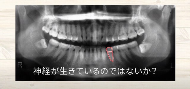 歯の神経が生きているか死んでいるかの判断なら香川県高松市の吉本歯科医院