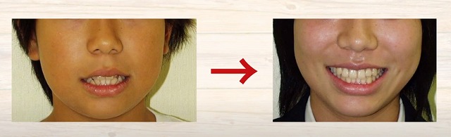 顔の筋肉の老化は噛み合わせ｜香川県高松市の吉本歯科医院