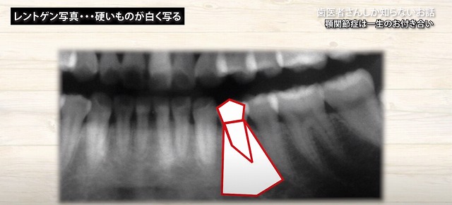 顎関節症の治し方｜香川県高松市の咬み合わせ専門　吉本歯科医院