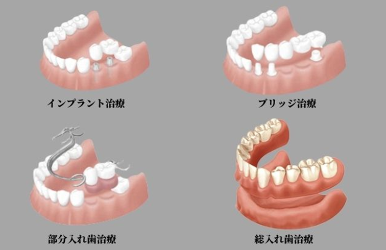 抜歯した後の治療の選択肢｜香川県高松市の吉本歯科医院