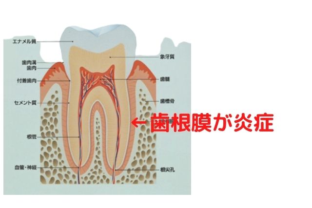 歯根膜が炎症｜香川県高松市の吉本歯科医院