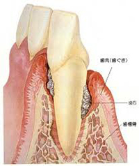 歯周病は感染症です 香川県高松市吉本歯科医院