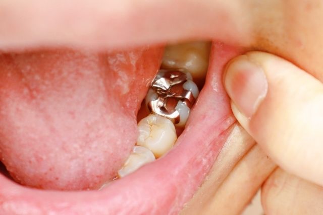 金属が体に良くないことをしって銀歯を外したいというご相談｜香川県高松市の吉本歯科医院