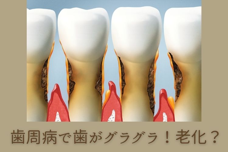虫歯治療で銀歯を被せるのは先進国では日本人だけ｜香川県高松市の咬み合わせ専門　吉本歯科医院