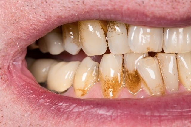 重度歯周病・ひどい歯瘻膿漏の原因と治療法｜香川県高松市の咬み合わせ専門　吉本歯科医院