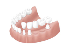 インプラント治療のメリット・デメリット｜香川県高松市の吉本歯科医院