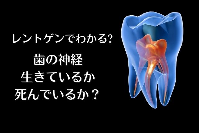 歯の神経が生きているか死んでいるかレントゲンでわかる？｜香川県高松市の吉本歯科医院