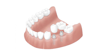 抜歯した後の治療の選択肢｜香川県高松市の吉本歯科医院