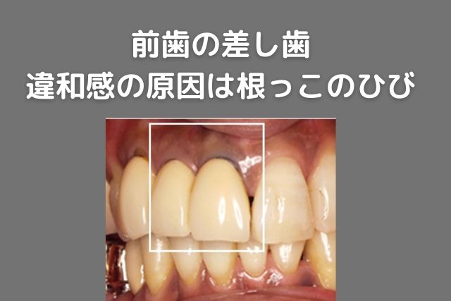 差し歯の土台が折れた場合｜香川県高松市の咬みあわせ専門　吉本歯科医院