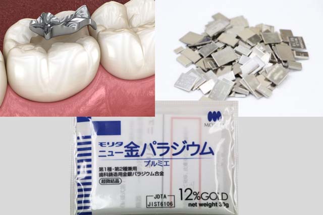 私が銀歯を入れない理由｜香川・高松の咬み合わせ専門歯科　吉本歯科医院