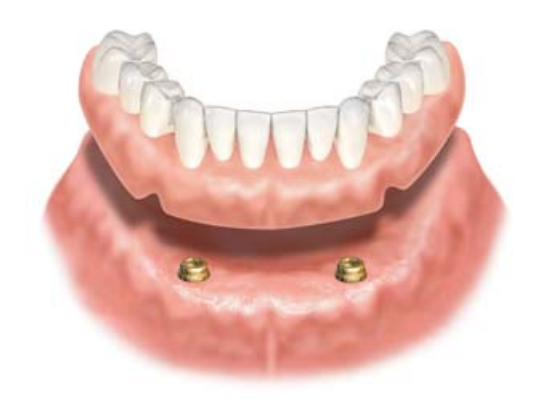 磁石で固定する入れ歯とインプラントの長所と短所