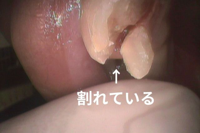 前歯が割れた場合の治療法｜香川県高松市の噛み合わせ専門歯科　吉本歯科医院