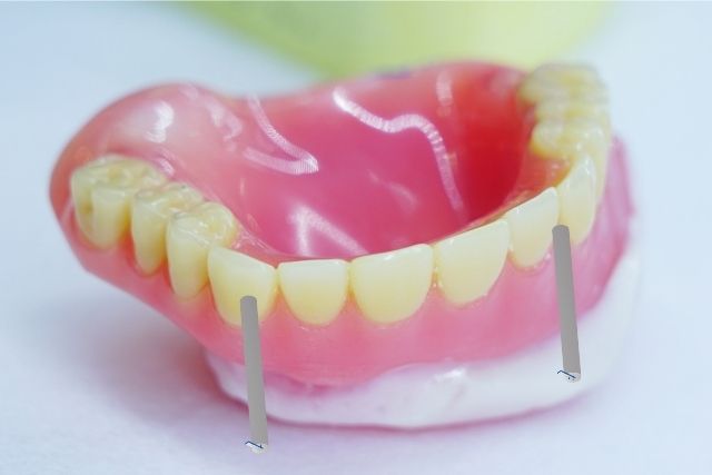 磁石で固定する入れ歯とインプラントの長所と短所