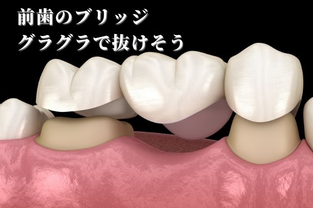 前歯のブリッジがグラグラで抜けそう。治療法は？｜香川県高松市の吉本歯科医院