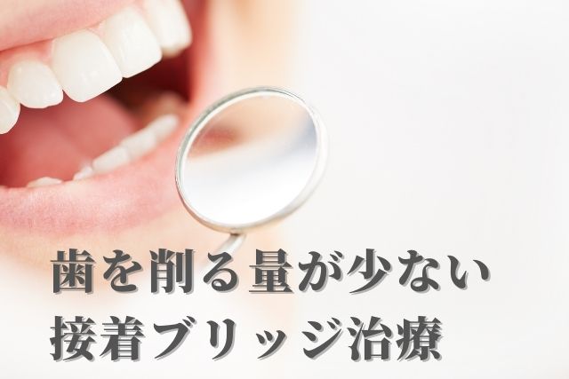 歯を削る量が少ない接着ブリッジなら香川県高松市の吉本歯科医院