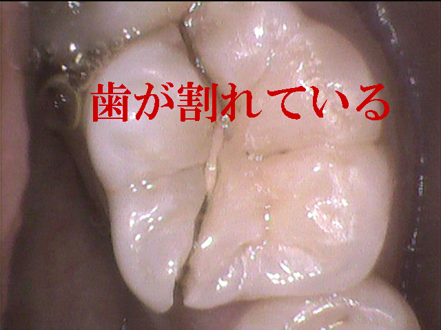 歯根破折 香川県高松市吉本歯科医院