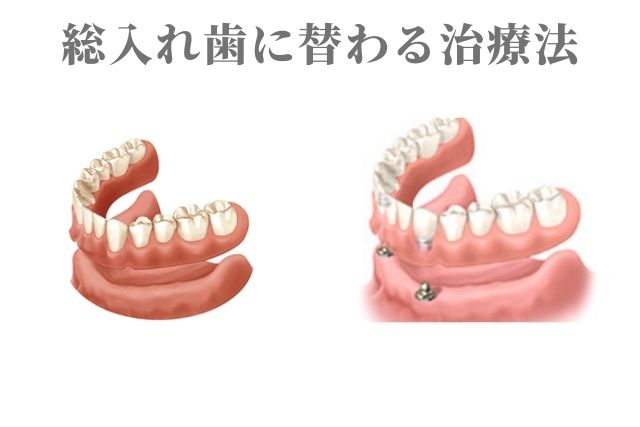 総入れ歯に替わる治療法｜インプラント治療による固定式入れ歯|香川県高松市の吉本歯科医院