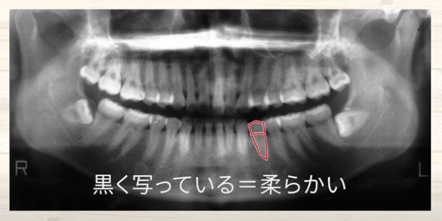 歯の神経が生きているか死んでいるかの判断なら香川県高松市の吉本歯科医院