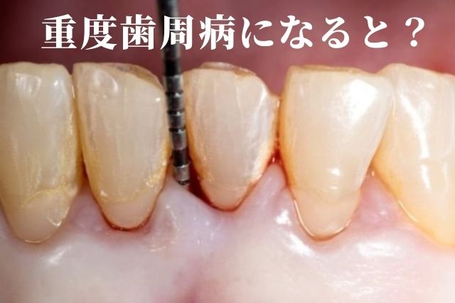 重度の歯周病は治りますか？｜香川・高松市の吉本歯科医院