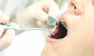 インプラントトラブルの８割は２年以内