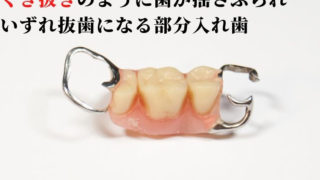 入れ歯のバネをひっかけた歯はまもなく揺れ始めます。