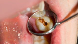 手遅れになる前に！多くの歯を失う前にしっておくこと