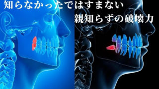 親知らずの破壊力！知らなかったではすみません。