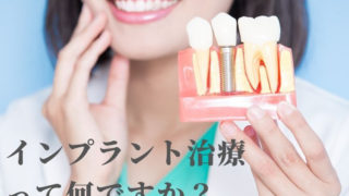 インプラント治療って何ですか？