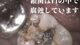 銀歯は口の中で腐蝕しはじめます。