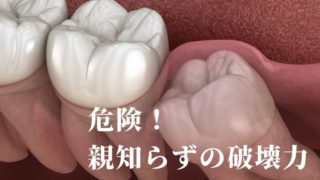 親知らずは抜いたほうがいいです。
