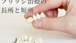 ブリッジ治療で歯を削る前に