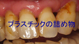 前歯の茶色い汚れが取れない