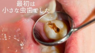 抜歯と診断。最初は小さな虫歯でした