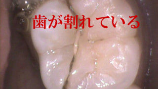 歯が割れている場合には抜歯？