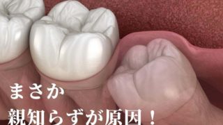 まさか親知らずが原因だったなんて！