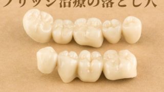 ブリッジが壊れたから、またブリッジ治療をしますか？