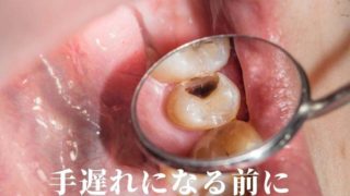 最初は小さな虫歯でした。手遅れになる前に原因を知って下さい。