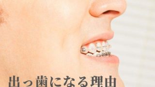 出っ歯になる原因