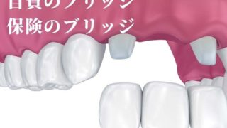 保険のブリッジ治療、自費のブリッジ治療の違い