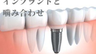 インプラント　上の被せ物が壊れて来院