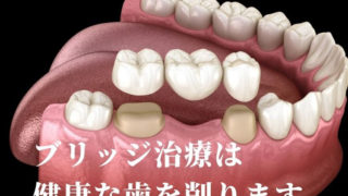 歯がない部分にブリッジ治療をする前に知っておくこと